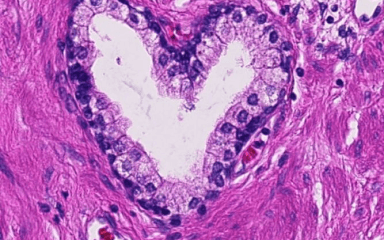 Lobulär bröstcancer ur en kirurgs perspektiv